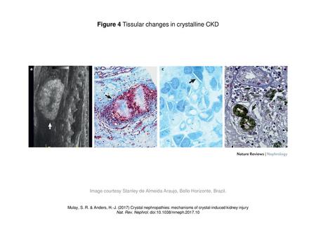 Figure 4 Tissular changes in crystalline CKD