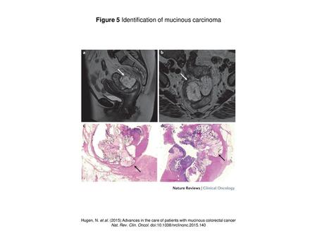 Figure 5 Identification of mucinous carcinoma