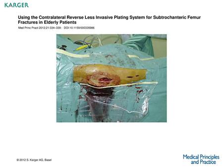 Using the Contralateral Reverse Less Invasive Plating System for Subtrochanteric Femur Fractures in Elderly Patients Med Princ Pract 2012;21:334–339 -