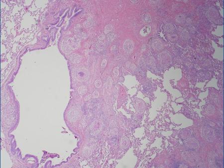 H M M IF Causes of Pulmonary Hypertension in Patients with Sarcoid Perivascular fibrosis Increased vasoreactivity Granulomas in pulmonary.