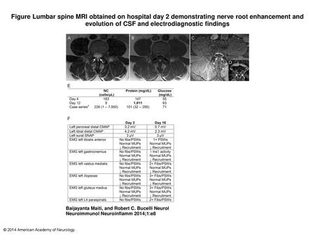 Figure Lumbar spine MRI obtained on hospital day 2 demonstrating nerve root enhancement and evolution of CSF and electrodiagnostic findings Lumbar spine.