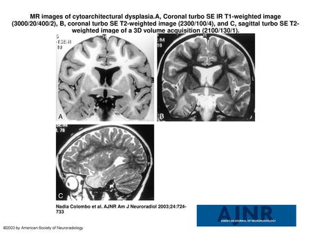 MR images of cytoarchitectural dysplasia