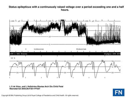  Status epilepticus with a continuously raised voltage over a period exceeding one and a half hours.  Status epilepticus with a continuously raised voltage.