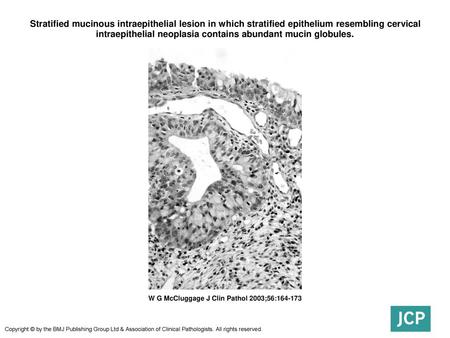 Stratified mucinous intraepithelial lesion in which stratified epithelium resembling cervical intraepithelial neoplasia contains abundant mucin globules.