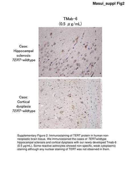 Case: Hippocampal sclerosis