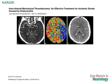 Intra-Arterial Mechanical Thrombectomy: An Effective Treatment for Ischemic Stroke Caused by Endocarditis Case Rep Neurol 2016;8:229–233 - DOI:10.1159/000452213.