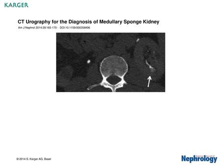 CT Urography for the Diagnosis of Medullary Sponge Kidney