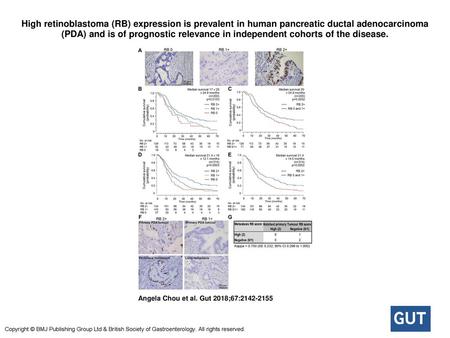 High retinoblastoma (RB) expression is prevalent in human pancreatic ductal adenocarcinoma (PDA) and is of prognostic relevance in independent cohorts.