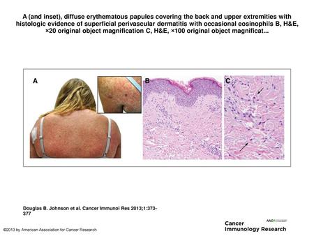 A (and inset), diffuse erythematous papules covering the back and upper extremities with histologic evidence of superficial perivascular dermatitis with.