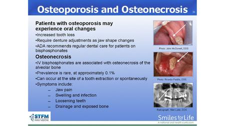 Patients with osteoporosis may experience oral changes, such as: