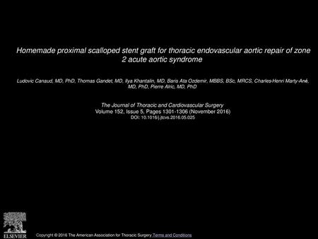 Homemade proximal scalloped stent graft for thoracic endovascular aortic repair of zone 2 acute aortic syndrome  Ludovic Canaud, MD, PhD, Thomas Gandet,