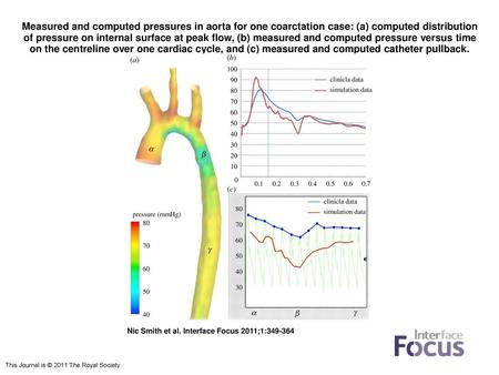 Measured and computed pressures in aorta for one coarctation case: (a) computed distribution of pressure on internal surface at peak flow, (b) measured.