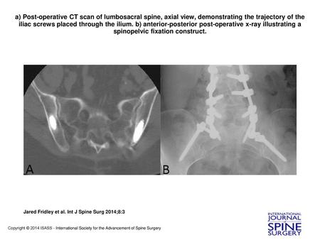 A) Post-operative CT scan of lumbosacral spine, axial view, demonstrating the trajectory of the iliac screws placed through the ilium. b) anterior-posterior.