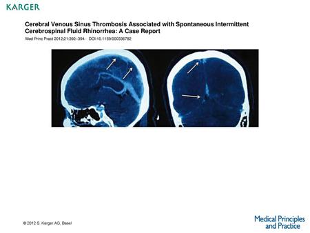 Cerebral Venous Sinus Thrombosis Associated with Spontaneous Intermittent Cerebrospinal Fluid Rhinorrhea: A Case Report Med Princ Pract 2012;21:392–394.