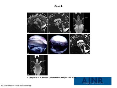 Case 4. Case 4. A, Sagittal TSE T2 image demonstrates enlarged third ventricle, extensive flow void phenomenon in the cerebral aqueduct, the fourth ventricle,