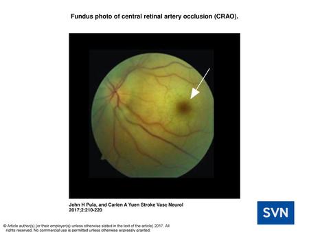 Fundus photo of central retinal artery occlusion (CRAO).