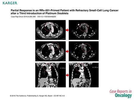 Partial Response in an RRx-001-Primed Patient with Refractory Small-Cell Lung Cancer after a Third Introduction of Platinum Doublets Case Rep Oncol 2016;9:285-289.