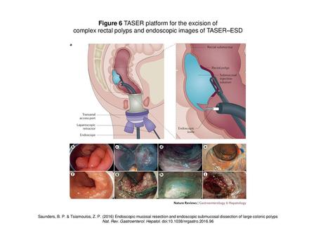 Figure 6 TASER platform for the excision of