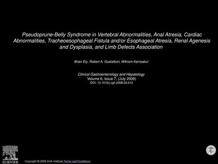 Pseudoprune-Belly Syndrome in Vertebral Abnormalities, Anal Atresia, Cardiac Abnormalities, Tracheoesophageal Fistula and/or Esophageal Atresia, Renal.