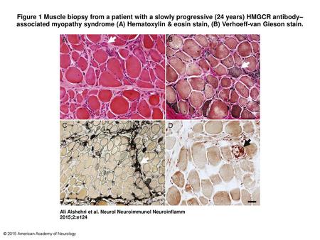 Figure 1 Muscle biopsy from a patient with a slowly progressive (24 years) HMGCR antibody–associated myopathy syndrome (A) Hematoxylin & eosin stain, (B)