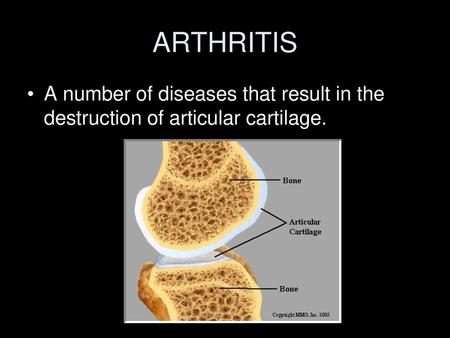 ARTHRITIS A number of diseases that result in the destruction of articular cartilage.