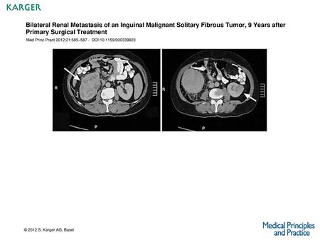 Bilateral Renal Metastasis of an Inguinal Malignant Solitary Fibrous Tumor, 9 Years after Primary Surgical Treatment Med Princ Pract 2012;21:585–587 -