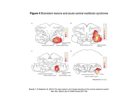 Figure 4 Brainstem lesions and acute central vestibular syndrome