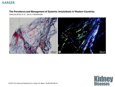 The Prevalence and Management of Systemic Amyloidosis in Western Countries Kidney Dis 2016;2:10-19 - DOI:10.1159/000444206 Fig. 1. A subcutaneous abdominal.