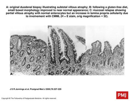 A: original duodenal biopsy illustrating subtotal villous atrophy; B: following a gluten-free diet, small bowel morphology improved to near normal appearance;