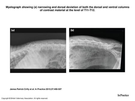 Myelograph showing (a) narrowing and dorsal deviation of both the dorsal and ventral columns of contrast material at the level of T11-T12. Myelograph showing.