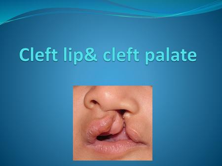 Cleft lip& cleft palate