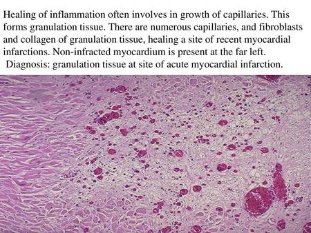 Healing of inflammation often involves in growth of capillaries