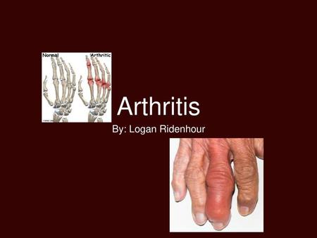 Arthritis By: Logan Ridenhour.