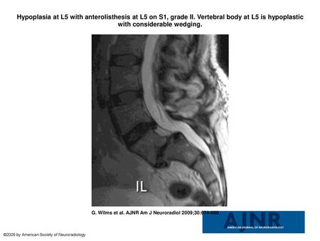 Hypoplasia at L5 with anterolisthesis at L5 on S1, grade II