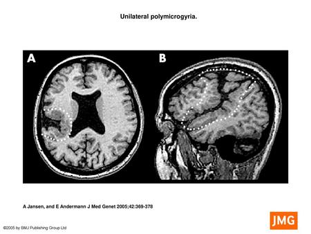 Unilateral polymicrogyria.