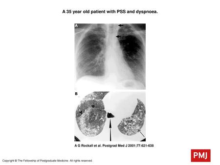 A 35 year old patient with PSS and dyspnoea.