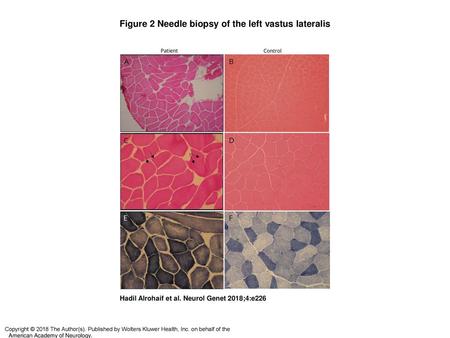 Figure 2 Needle biopsy of the left vastus lateralis