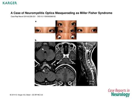 A Case of Neuromyelitis Optica Masquerading as Miller Fisher Syndrome