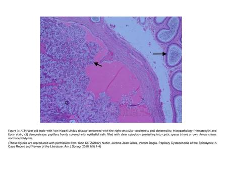 Figure 3: A 34-year-old male with Von Hippel-Lindau disease presented with the right testicular tenderness and abnormality. Histopathology (Hematoxylin.