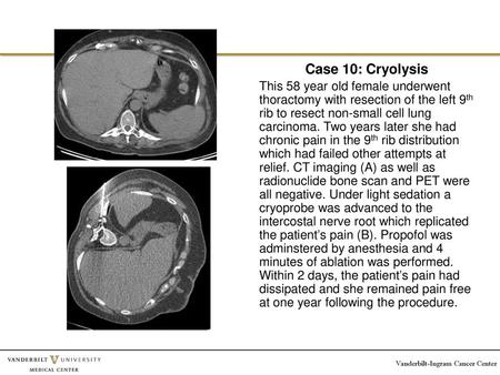 Case 10: Cryolysis This 58 year old female underwent thoractomy with resection of the left 9th rib to resect non-small cell lung carcinoma. Two years later.