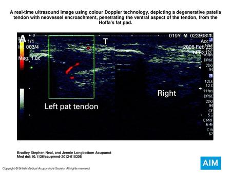 A real-time ultrasound image using colour Doppler technology, depicting a degenerative patella tendon with neovessel encroachment, penetrating the ventral.