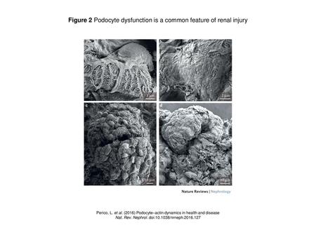 Figure 2 Podocyte dysfunction is a common feature of renal injury