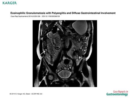 Case Rep Gastroenterol 2014;8: DOI: /