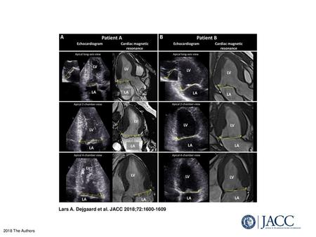 Lars A. Dejgaard et al. JACC 2018;72: