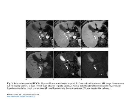 Fig. 3. Sub-centimeter-sized HCC in 56-year-old man with chronic hepatitis B. Gadoxetic acid-enhanced MR image demonstrates 0.8-cm nodule (arrows) in right.