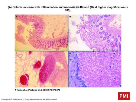 (A) Colonic mucosa with inflammation and necrosis (× 40) and (B) at higher magnification (× 100). (A) Colonic mucosa with inflammation and necrosis (×