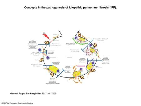 Concepts in the pathogenesis of idiopathic pulmonary fibrosis (IPF).