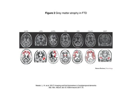 Figure 2 Grey matter atrophy in FTD