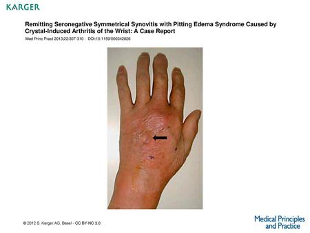 Remitting Seronegative Symmetrical Synovitis with Pitting Edema Syndrome Caused by Crystal-Induced Arthritis of the Wrist: A Case Report Med Princ Pract.