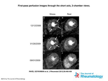 First-pass perfusion images through the short axis, 2-chamber views.